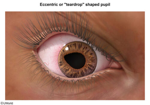 EccentricOrTeardropShapedPupil