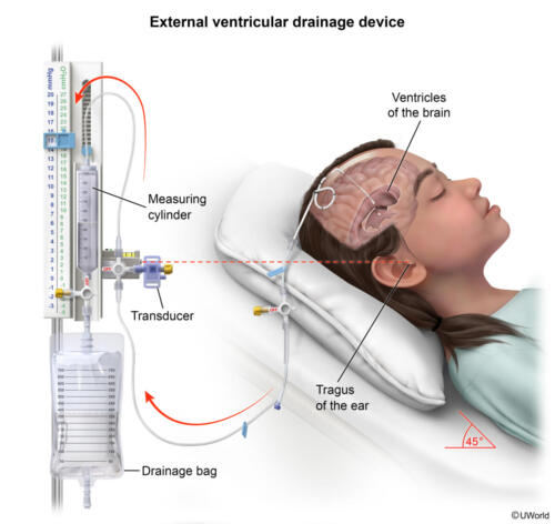 ExternalVentricularDrainageDevice-Print